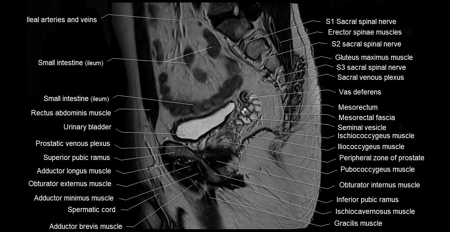male pelvis sagittal cross sectional anatomy 3T mri image 29.webp